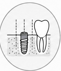 Schematische Darstellung der digitalen Implantatplanung