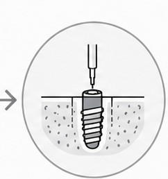 Schematische Darstellung der geführten Implantation