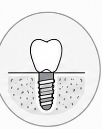 Schematische Darstellung des finalen Zahnersatzes auf einem Implantat